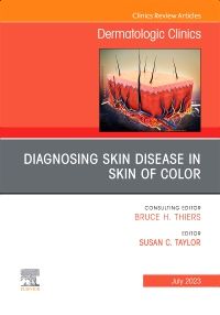 Diagnosing Skin Disease in Skin of Color, An Issue of Dermatologic Clinics, E-Book