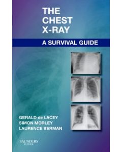 The Chest X-Ray: A Survival Guide